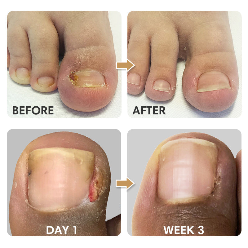 Fertoe Toenail Corrector Patch