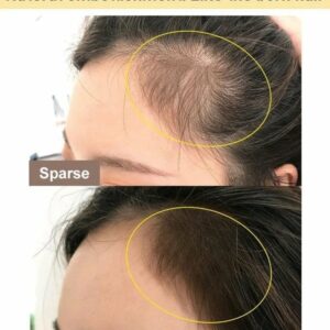 Hairline Contouring