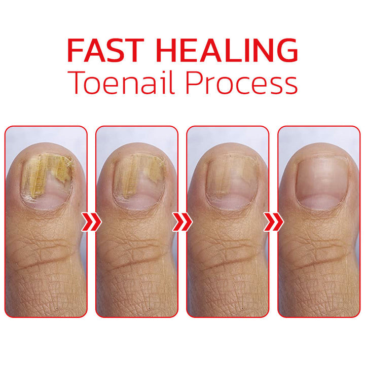 NailHelper Ingrowth Toenail Correction Treatment Oil