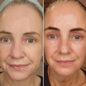 NuSculpt Facial Toning Device