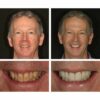 Last Day Promotion 50% OFF - Teeth Whitening Essence