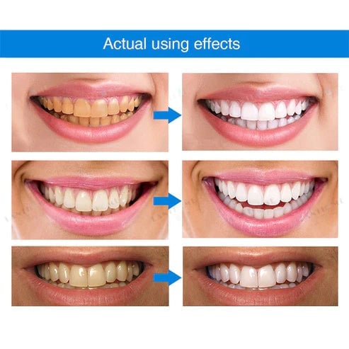 Last Day Promotion 50% OFF - Teeth Whitening Essence