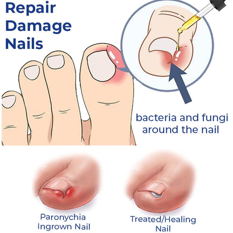 German ToenailCare Removal Paronychia Oil