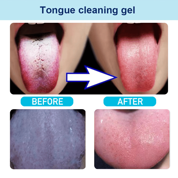 HOT SALE 60% OFF - Probiotic Tongue Cleaning Gel Set