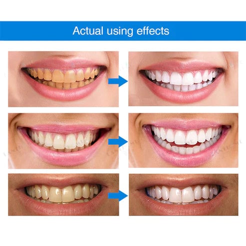 Last Day Promotion 50% OFF - Teeth Whitening Essence