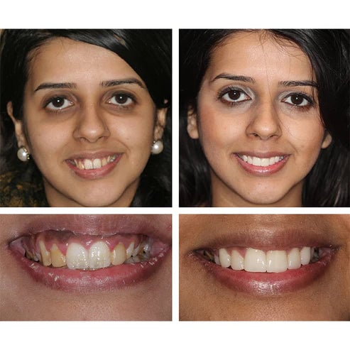 Last Day Promotion 50% OFF - Teeth Whitening Essence