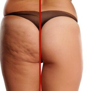 Slimming Cellulite Remover