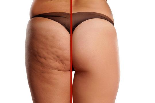 Slimming Cellulite Remover