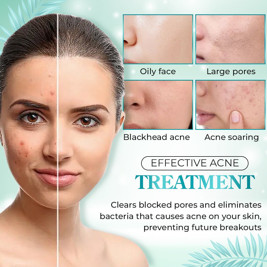 Spring Sale - Buy 2 Get 1 Free - Salicylic Acid Acne Treatment Cream