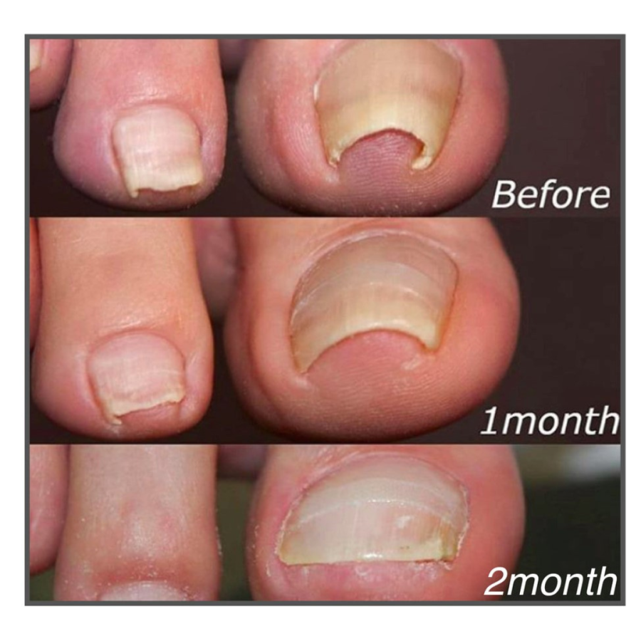 Correction patches for beautiful and healthy nails