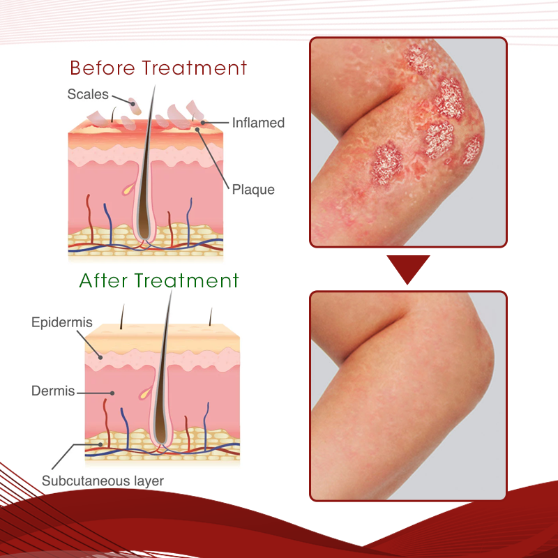 DermaCure Psoriasis Spray