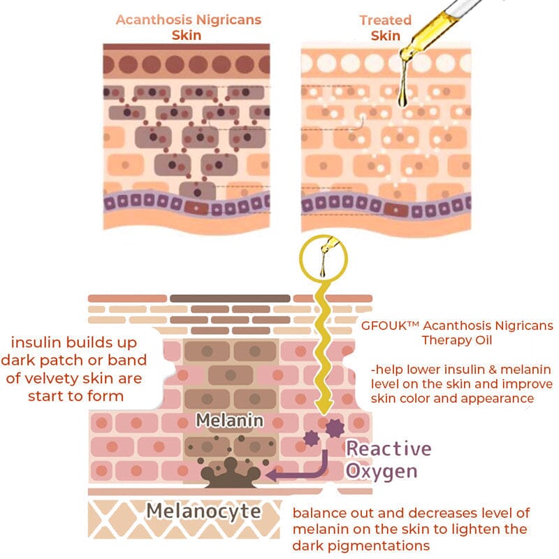 GFOUK Acanthosis Nigricans Therapy Drops