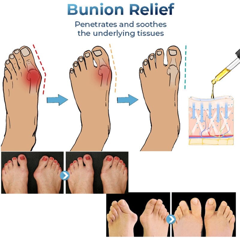 GFOUK German Bunion Therapy Oil