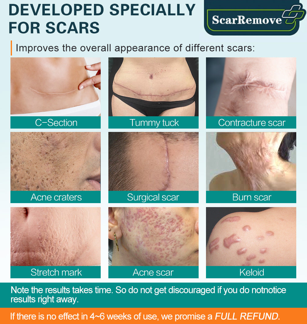 ScarRemove Advanced Scar Spray For All Types of Scars - Especially Acne Scars, Surgical Scars and Stretch Marks