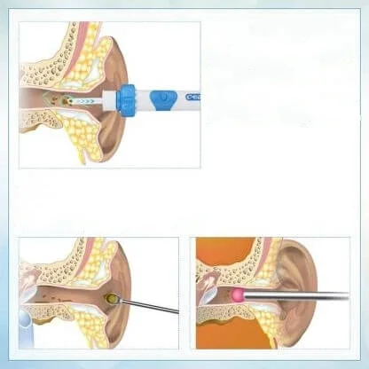 EARSIO earwax vacuum cleaner