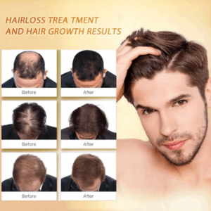 PURC Hair Regrowth Treatment For Anti Hair Loss & Hair Growth