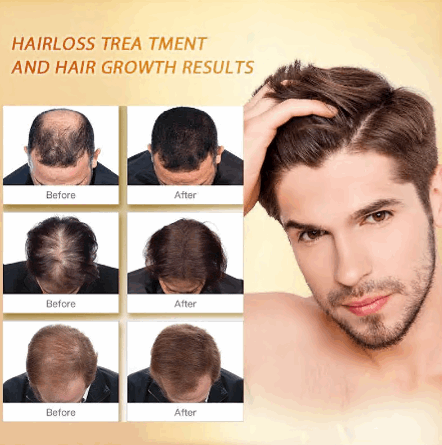 PURC Hair Regrowth Treatment For Anti Hair Loss & Hair Growth