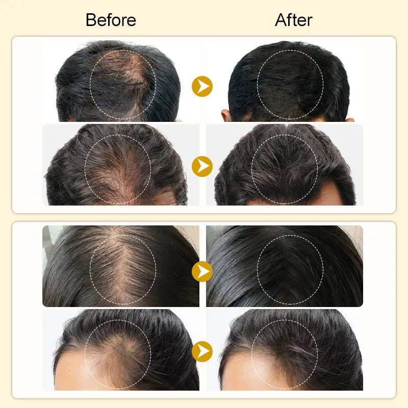 PURC Hair Regrowth Treatment For Anti Hair Loss & Hair Growth