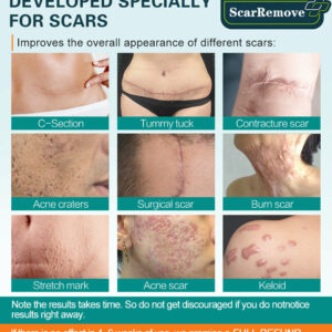 ScarRemove Advanced Scar Spray For All Types of Scars – For example Acne Scars, Surgical Scars and Stretch Marks