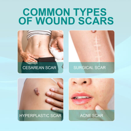 ADVANCED SCAR SPRAY FOR ALL TYPES OF SCARS - FOR EXAMPLE ACNE SCARS, SURGICAL SCARS AND STRETCH MARKS