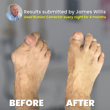 Hallux Valgus Bunion Corrector (LAST DAY 40% SALE OFF)