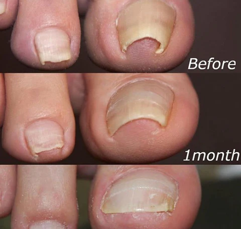 Nail Correction Patches 