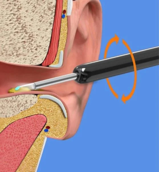 ProScope Smart Ear Cleaner