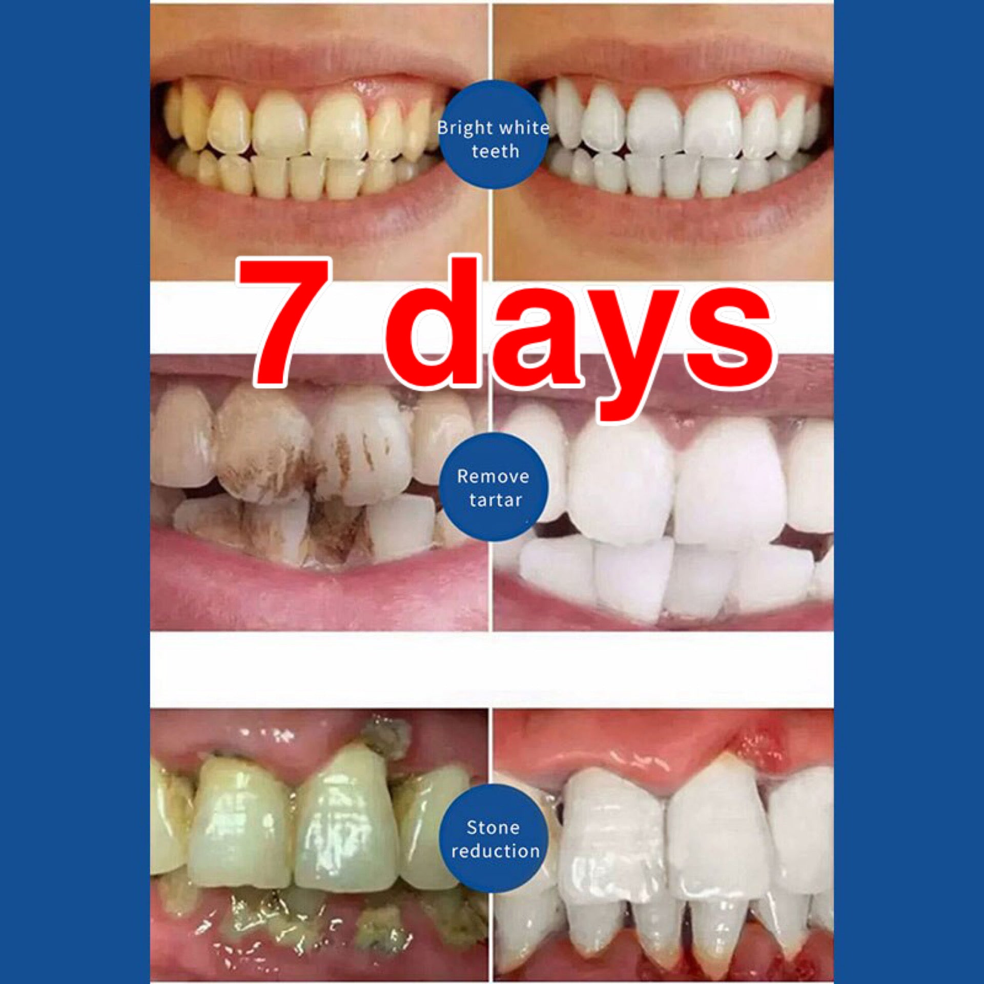 Yizman (Today Only Sale 50 %OFF + Buy two get one free) Quick Repair of Cavities Caries Removal of Plaque Stains Decay Whitening Yellowing Repair Teeth Teeth Whitening