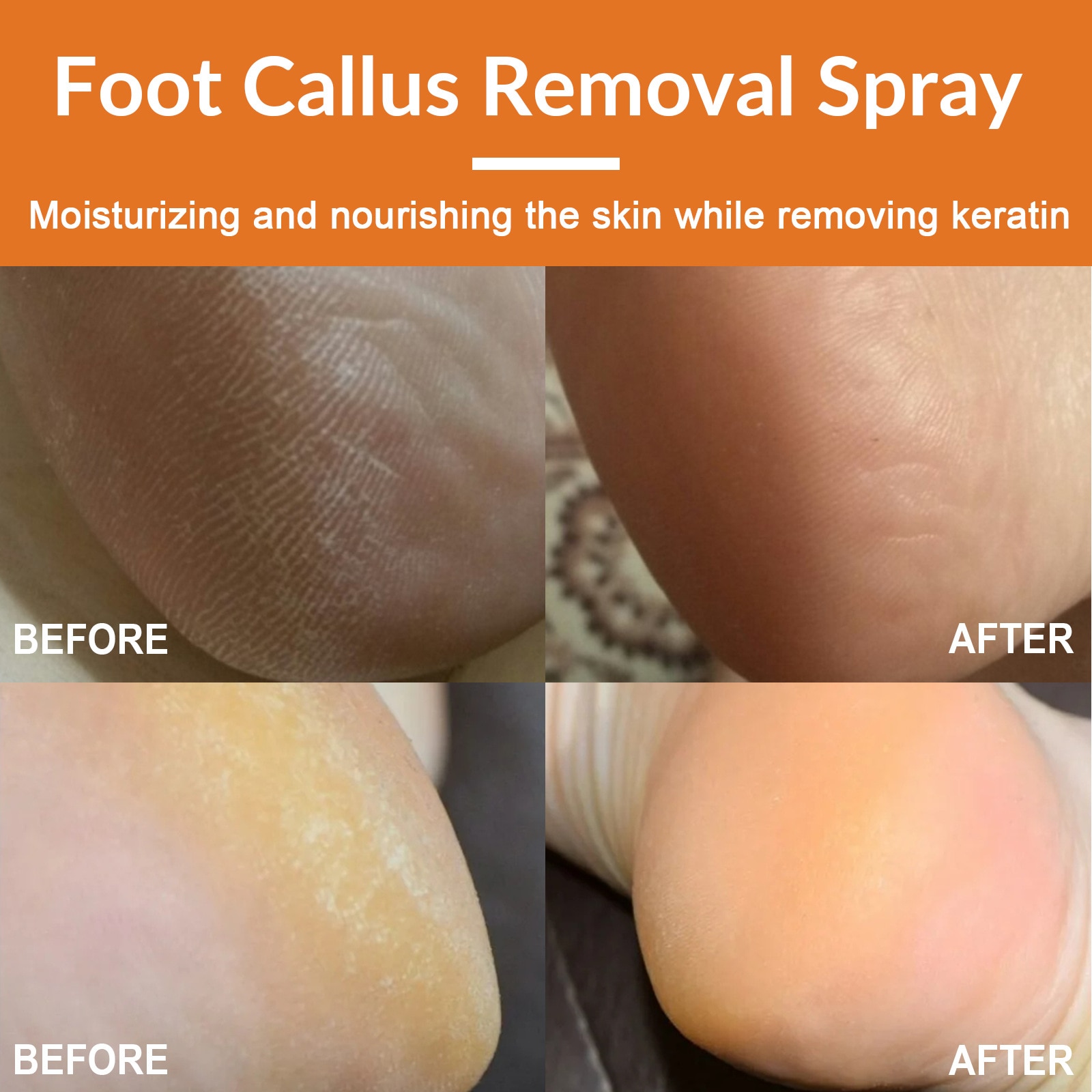 GFOUK Foot Callus Removal Spray