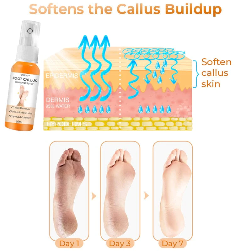 (Limited Time Discount – Last Day 70% Off) GFOUK Foot Callus Removal Spray