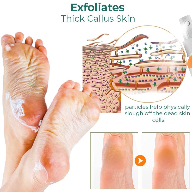 (Limited Time Discount - Last Day 70% Off) GFOUK Foot Callus Removal Spray