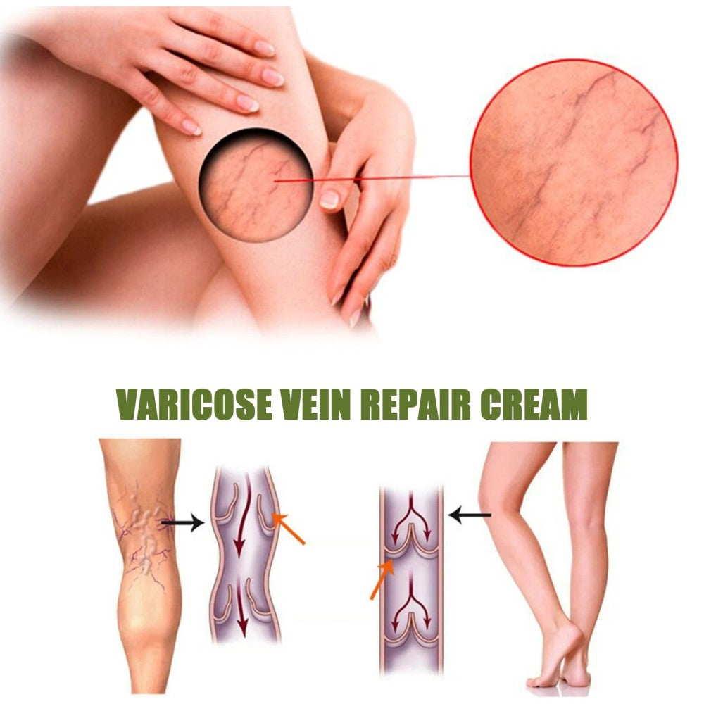 MEDix Varicose Veins Spray