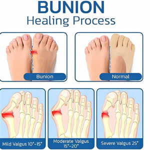 FeetFirst – Bunion Relief Socks