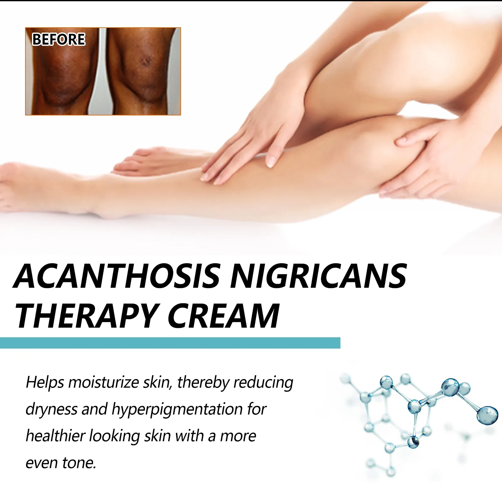 Hot Sale 60% OFF - EELHOE-Acanthosis Nigricans Therapy Cream- Reduces Dark Elbows, Knees, Underarms,Bikini Area & Neck