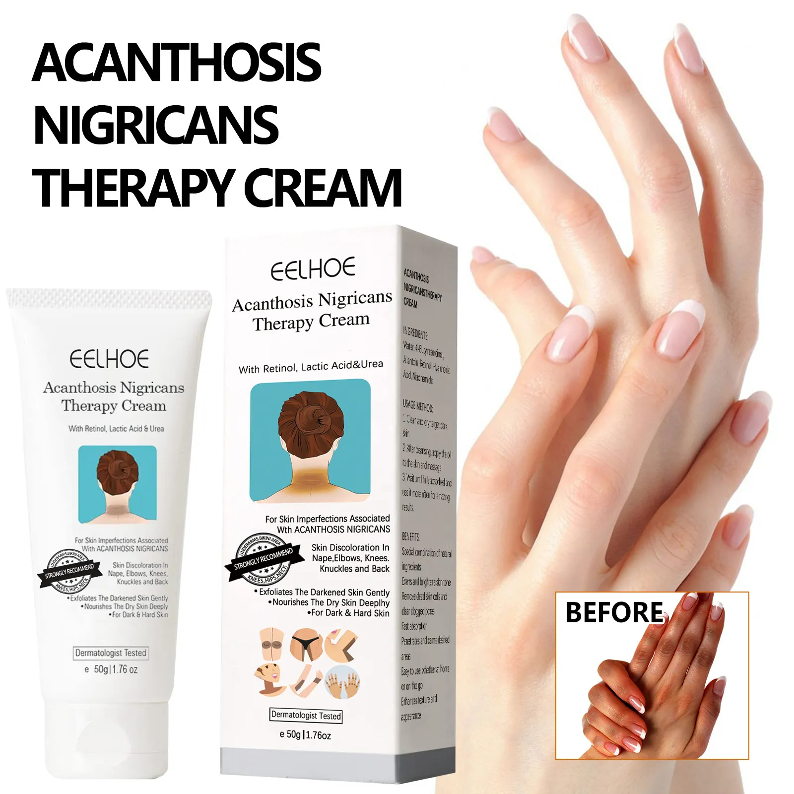 Hot Sale 60% OFF - EELHOE-Acanthosis Nigricans Therapy Cream- Reduces Dark Elbows, Knees, Underarms,Bikini Area & Neck