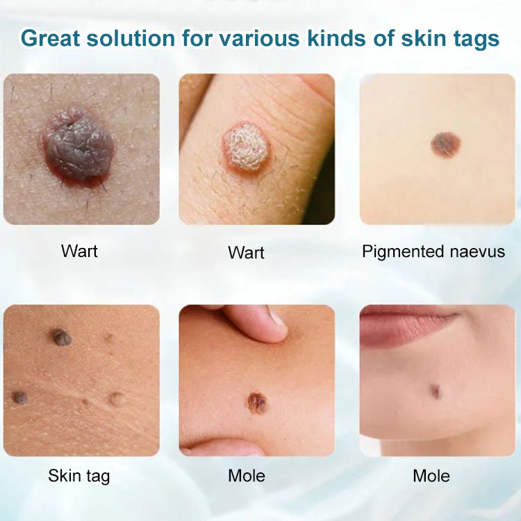 LAST DAY 70% OFF - Concentrated Potent Skin Tag Removal Cream