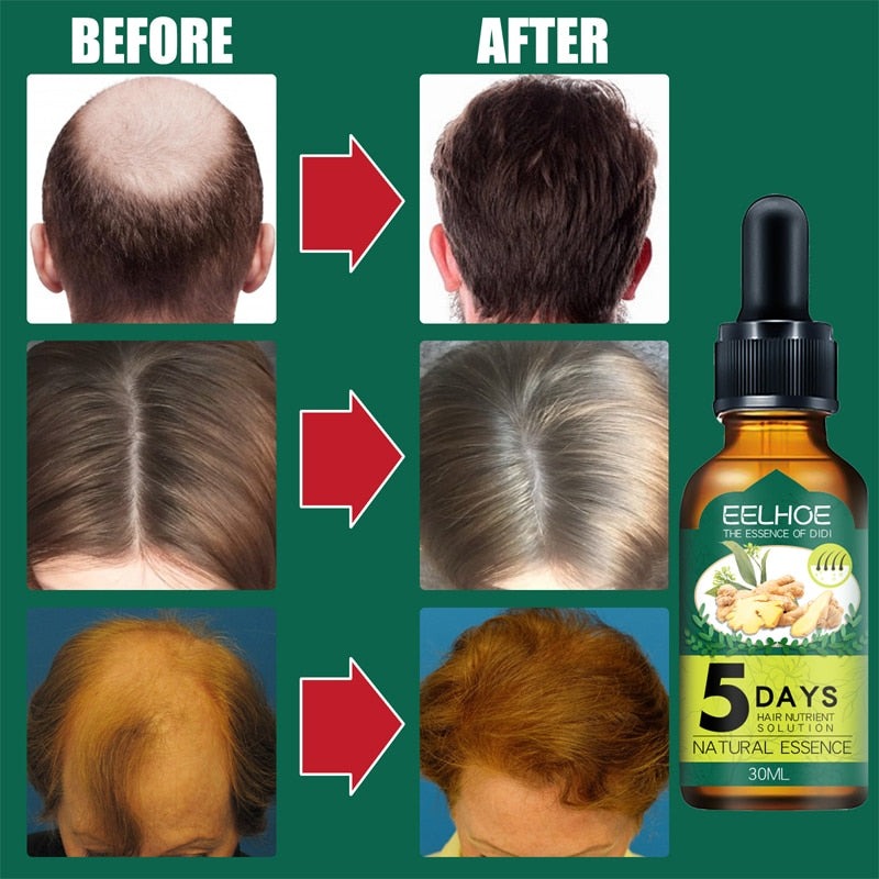 (LAST DAY SALE 50% OFF) ORIGINPRO Ginger Hair Regrowth Essence