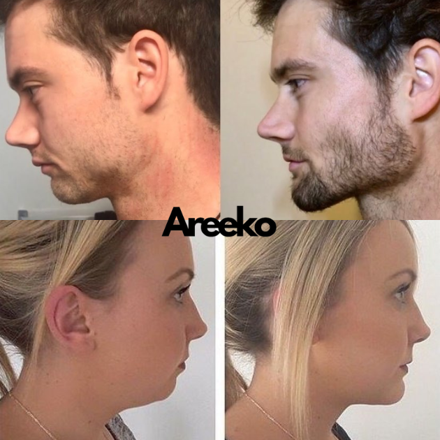 Areeko Jaw Trainer | Advanced Facial Exerciser