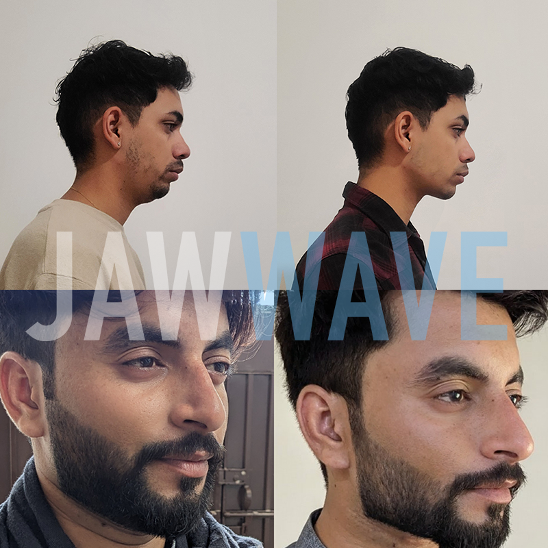 Jaw Wave Advanced Facial Exerciser