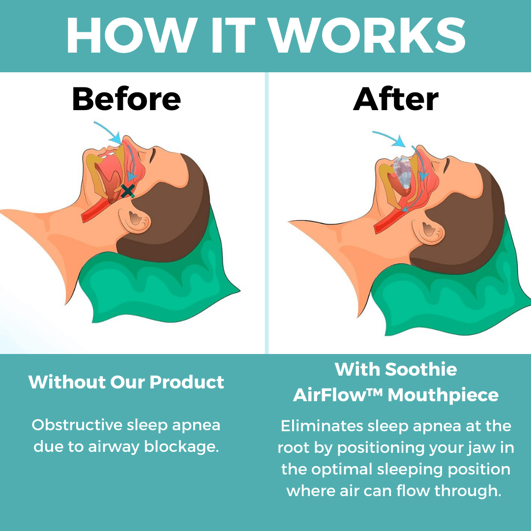 Soothie - Airflow Sleep Apnea Mouthguard