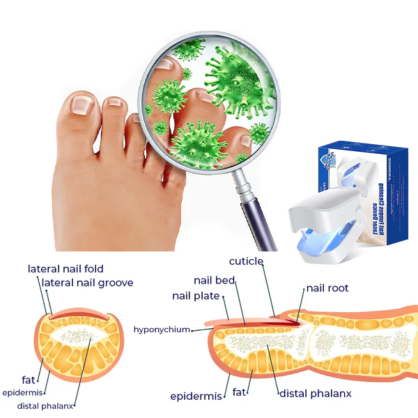 Oveallgo -  PROMAX Revolutionary High-Efficiency Light Therapy Device For Toenail Diseases