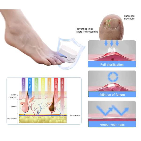 Oveallgo -  PROMAX Revolutionary High-Efficiency Light Therapy Device For Toenail Diseases