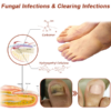 Oveallgo ProX Revolutionary High-Efficiency Light Therapy Device For Toenail Diseases