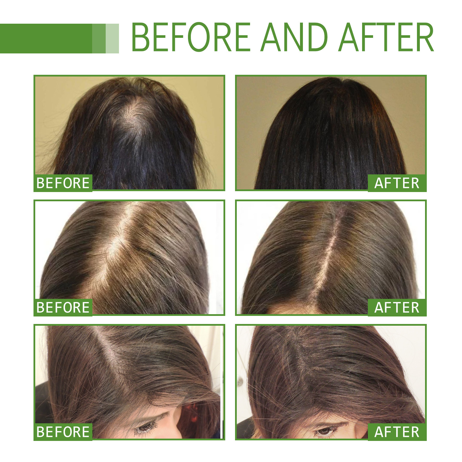 Shelure Hair Regrowth Treatment Advanced