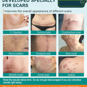 Advanced Scar Spray For All Types of Scars – For example Acne Scars, Surgical Scars and Stretch Marks