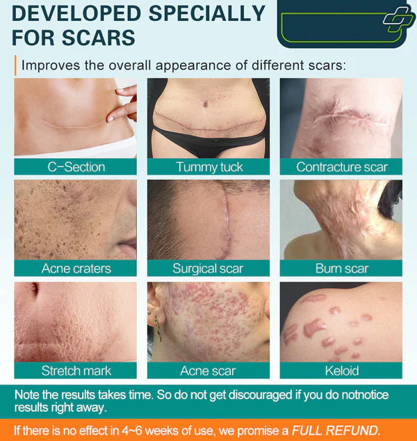 Advanced Scar Spray For All Types of Scars - For example Acne Scars, Surgical Scars and Stretch Marks 