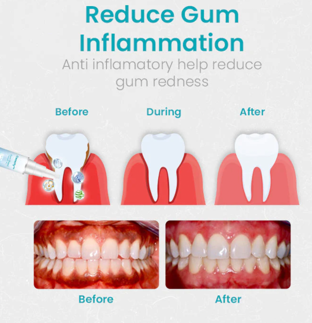 Ceoerty Gum Shield Therapy Gel