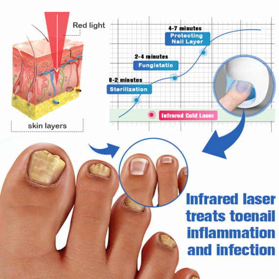 Furzero Nail Fungus Cleaning Laser Relief Device - Lulunami