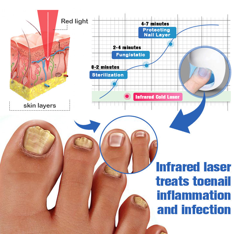 Furzero Nail Fungus Cleaning Laser Relief Device