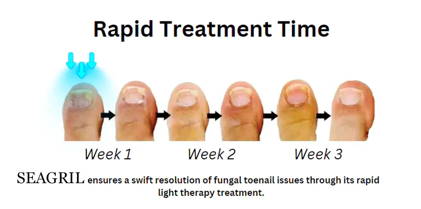 SEAGRIL PROMAX Revolutionary Light Therapy Device For Toenail Diseases